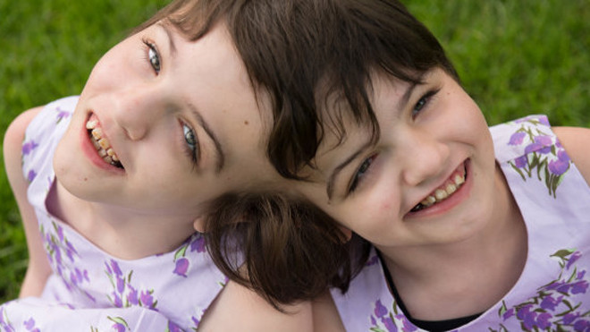 Cuộc sống kỳ lạ của cặp song sinh dính đầu, chung sọ não biết mọi suy nghĩ của nhau Ảnh 2