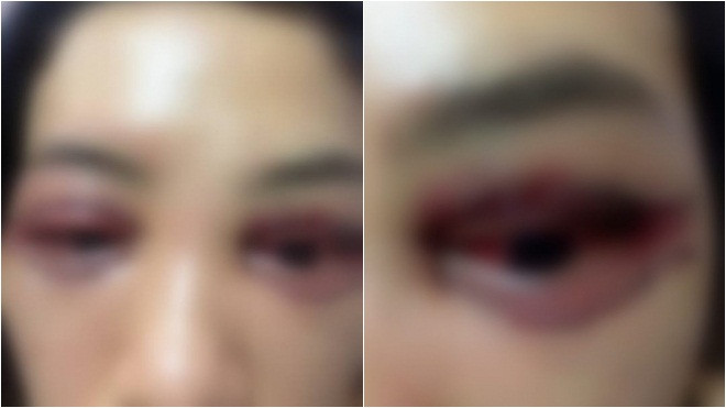 Khách nữ tố Spa cắt mí mắt hỏng còn bắt livestream xin lỗi: ‘2 bên đã tự hòa giải, mắt tôi không sao rồi’ Ảnh 2