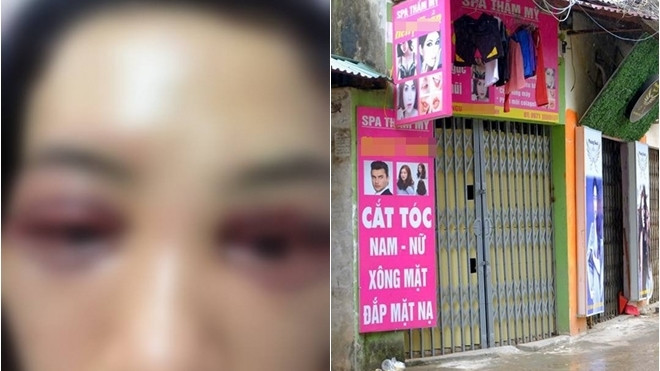 Sở Y tế Hà Nội chỉ đạo làm rõ vụ nữ khách hàng bị hỏng mí mắt tại Spa Ảnh 2