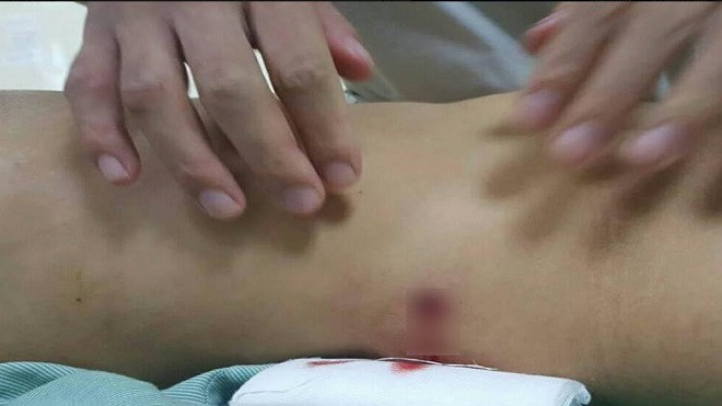 Cứu sống cô gái bị đạn xuyên thủng đại tràng khi đang đi đường Ảnh 2