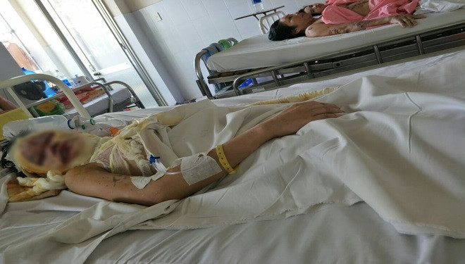 Thiếu nữ miền Tây bị tạt axit hủy hoại cả khuôn mặt lúc tan ca Ảnh 2