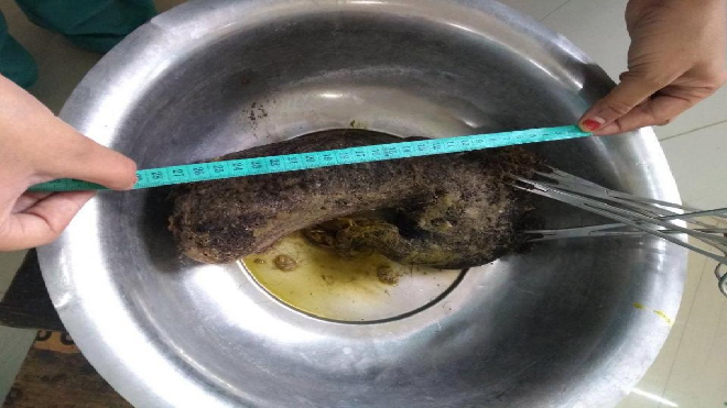 Đau bụng dữ dội sau sinh, người phụ nữ 'suýt ngất' khi lấy vật thể lạ từ trong bụng Ảnh 2