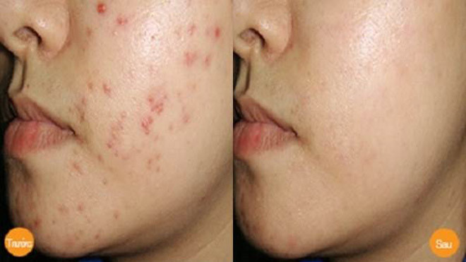 Mụn thâm nhiều chi chít cũng biến mất nhờ mẹo vặt này Ảnh 2