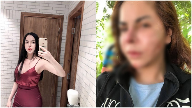 Hotgirl chuyển giới Linda bất ngờ chia sẻ ảnh khuôn mặt bị biến dạng hơn 70% sau khi nạo silicon Ảnh 2