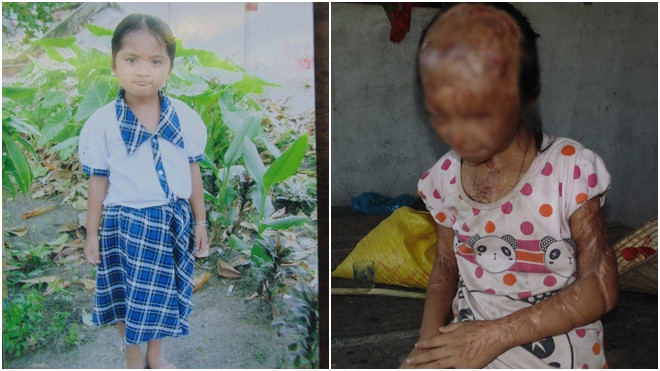 Cuộc sống mù lòa của cô bé 12 tuổi sau 5 năm hứng trọn can a xít trong trận đánh ghen kinh hoàng Ảnh 2