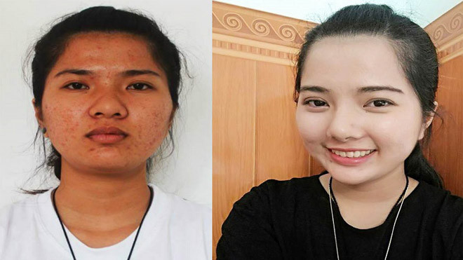 Cô gái Quảng Trị sốc vì khuôn mặt 'xinh như hoa' của chính mình sau thẩm mỹ Ảnh 2