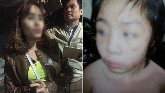 Mẹ bé trai bị bạo hành gãy xương sườn, rạn sọ não: ‘Nhìn con tôi xót quá, 2 mẹ con cứ thế ôm nhau khóc' Ảnh 2