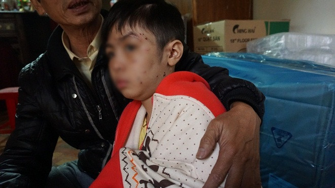 Bé trai 10 tuổi bị cha và mẹ kế đánh gãy tay: ‘2 năm rồi con mới được ăn bát phở’ Ảnh 2