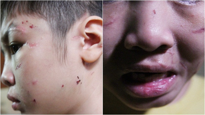 Rơi nước mắt nhìn những vết sẹo chi chít trên cơ thể bé trai 10 tuổi bị cha ruột bạo hành Ảnh 2