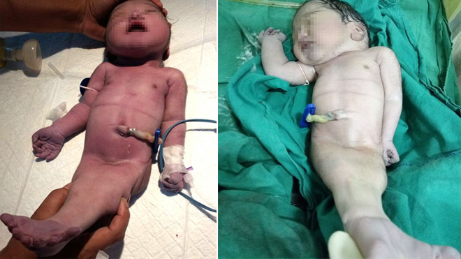 Mẹ sốc khi sinh con như người cá, 4 giờ sau lại nhận tin dữ Ảnh 2
