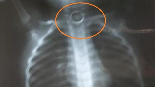 Cô giáo bất lực vì không có tiền chuyển viện cho con Ảnh 2