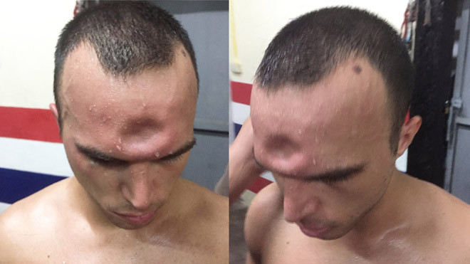 Võ sĩ Muay Thái lõm trán vì dính cú đòn cùi chỏ tàn khốc của đối thủ Ảnh 2