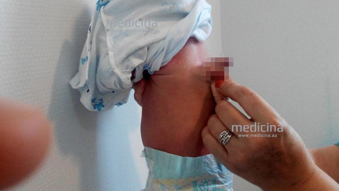 Kỳ lạ cậu bé sinh ra với 'dương vật' gắn trên lưng Ảnh 2