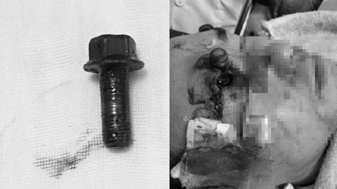 Hy hữu: Ốc vít dài bắn qua mắt, xuyên vỡ sọ Ảnh 2