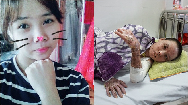 Cô gái xinh đẹp không may bỏng nặng: 'Nhan sắc không quan trọng nữa, chỉ mong sớm khỏi bệnh' Ảnh 2