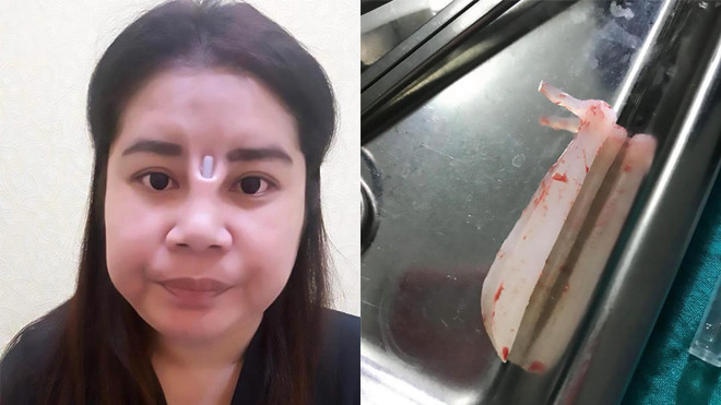 Ham hố nâng mũi giá rẻ, cô gái nhận cái kết không thể đắng hơn Ảnh 2