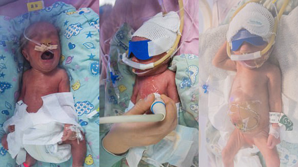 Ca sinh ba đặc biệt nhất thế giới: Mẹ vật vã 2 ngày mới sinh trọn bộ ba Ảnh 2