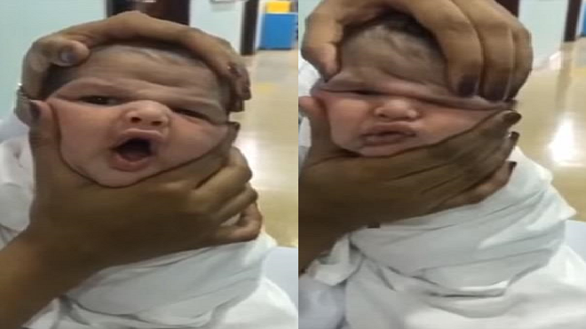 Làm bẹp mặt bé sơ sinh, nhóm y tá gây phẫn nộ đã bị sa thải Ảnh 2