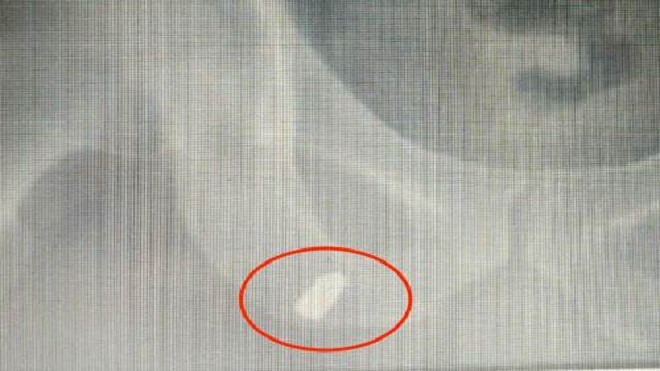 Bị đạn lạc găm trúng đùi khi đang làm đồng Ảnh 2