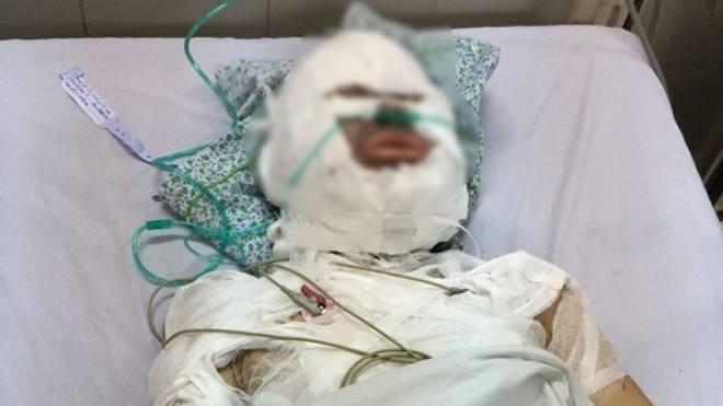 Níu kéo tình cảm không được, người đàn ông ngoại quốc tẩm xăng đốt bạn gái Ảnh 2