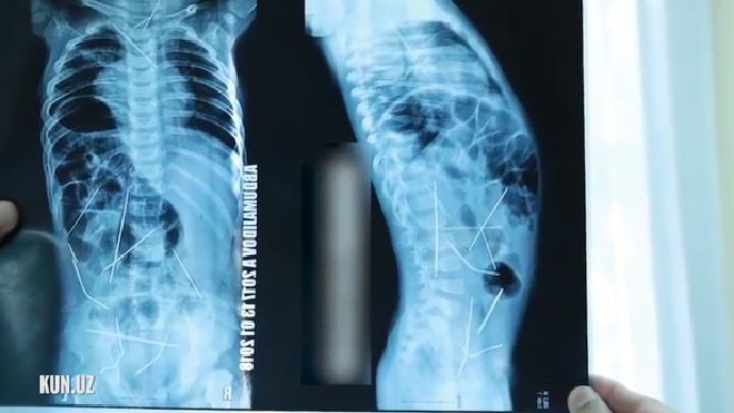 Bà mẹ suýt ngất khi phát hiện 16 cây kim khâu trong cơ thể đứa con 11 tháng tuổi Ảnh 2