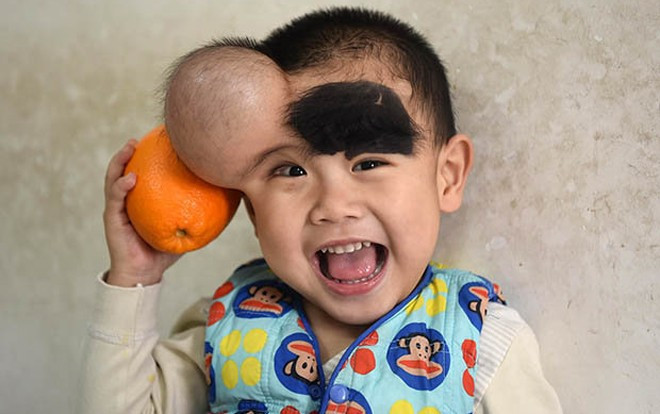 Cậu bé có khối u to như quả cam trên mặt và bệnh ung thư bủa vây từ tấm bé Ảnh 2