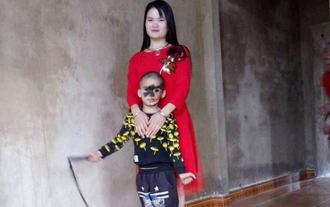 Cái Tết trọn vẹn đầu tiên của cậu bé 6 tuổi có khuôn mặt tựa “người rừng” tại Yên Bái Ảnh 2