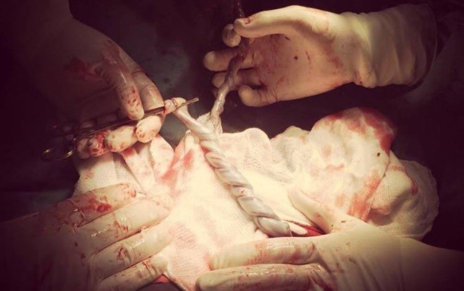 Hi hữu ca sinh đôi có 2 dây rốn xoắn như tết tóc Ảnh 2