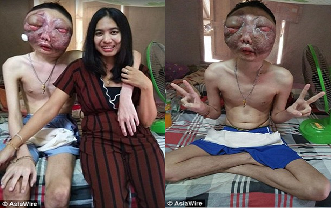 Chàng trai biến dạng mặt do ung thư, cô gái vẫn một lòng yêu thương hết mực Ảnh 2