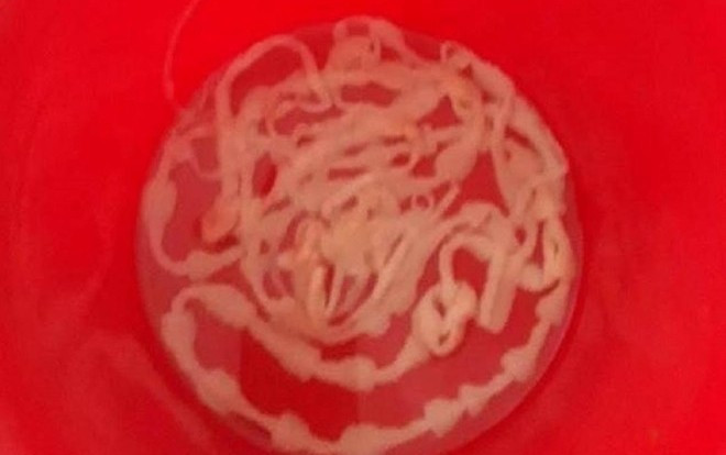 “Lôi” con sán xơ mít dài 8m sống trong cơ thể bệnh nhân Ảnh 2