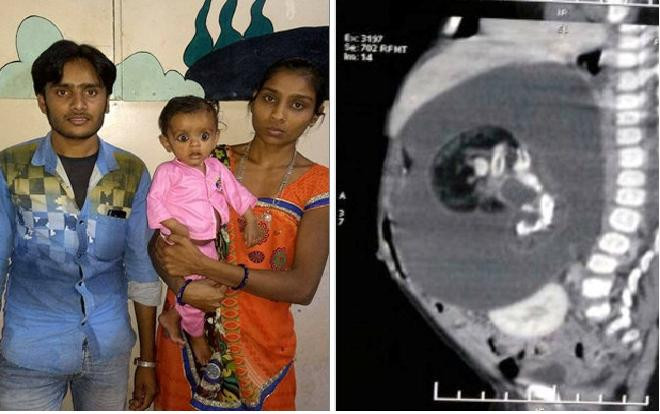 KINH NGẠC: Bào thai trong cơ thể đứa trẻ 7 tháng tuổi Ảnh 2