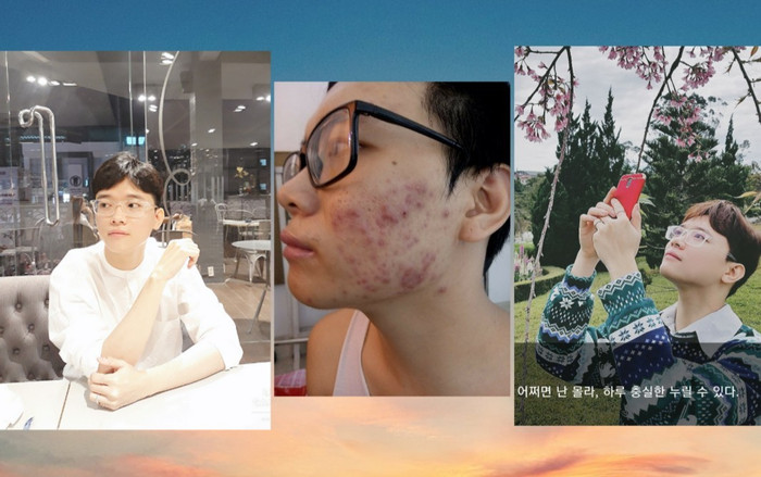 Chỉ tốn 10 nghìn đồng, chàng trai bị mụn mủ lâu năm bỗng trắng mịn bất ngờ Ảnh 2