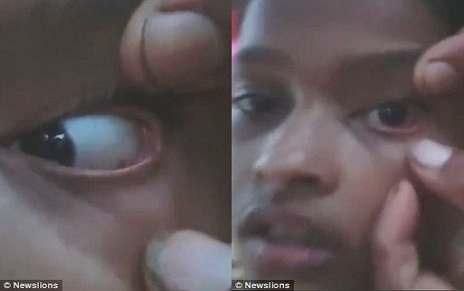 Kinh hoàng phát hiện 60 con kiến bò ra từ mắt bé gái 11 tuổi Ảnh 2