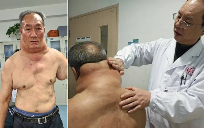 Uống một lít rượu mỗi ngày suốt hơn 25 năm, người đàn ông khốn khổ vì bệnh hiếm Ảnh 2