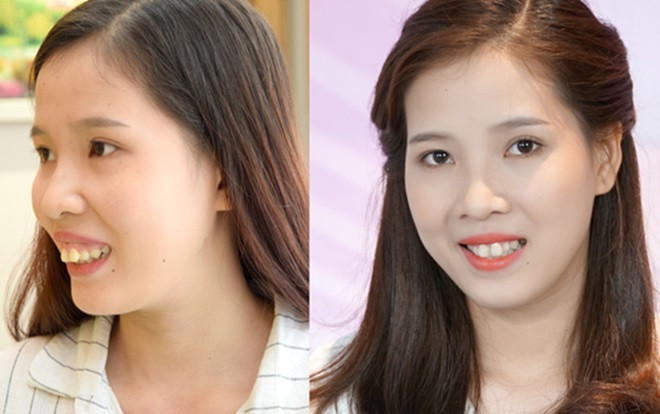 Cô gái hàm hô thay đổi ‘trang sách mới’ cho cuộc đời nhờ phẫu thuật thẩm mỹ Ảnh 2