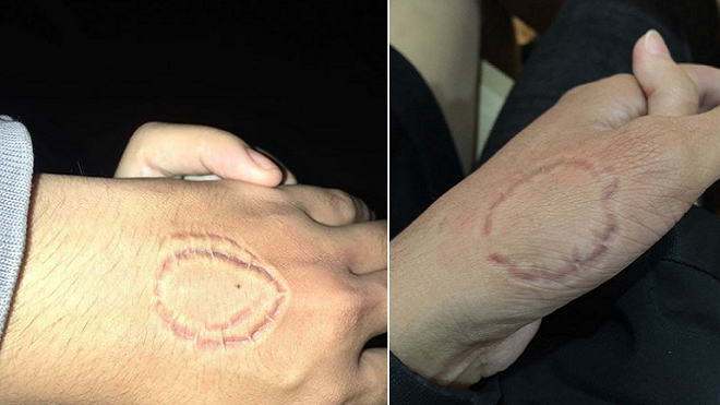 Lên mạng khoe vết cắn yêu 'đáng sợ' của bạn gái, thanh niên không ngờ lại được đồng cảm đến vậy Ảnh 2