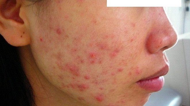 Tâm sự của cô gái dành cả thanh xuân đi xin việc nhưng đều bị từ chối vì mặt mụn Ảnh 2