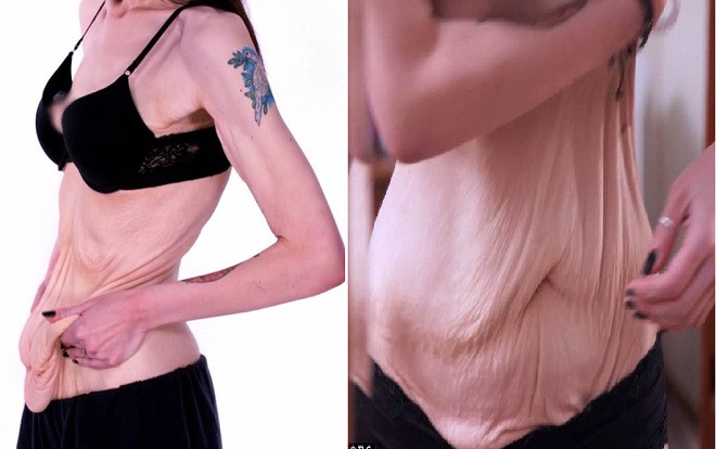 Hậu giảm cân, cô gái bị trầm cảm nặng vì làn da chảy xệ Ảnh 2