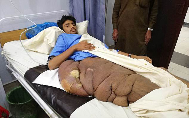 Chàng trai 18 tuổi có khối u khổng lồ bên hông khiến bác sĩ choáng váng Ảnh 2