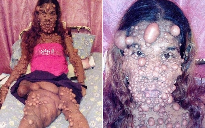 Nỗi đau của người phụ nữ nổi u như 'bong bóng' chi chít từ mặt tới chân Ảnh 2
