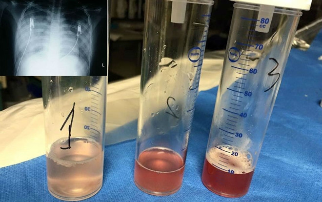 Nhiều lần ho ra máu, gia đình bé gái bàng hoàng biết con mắc bệnh hiếm gặp nhất thế giới Ảnh 2