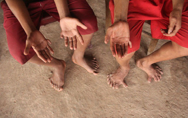 Kỳ lạ gia đình có 14 ngón chân, 12 ngón tay Ảnh 2