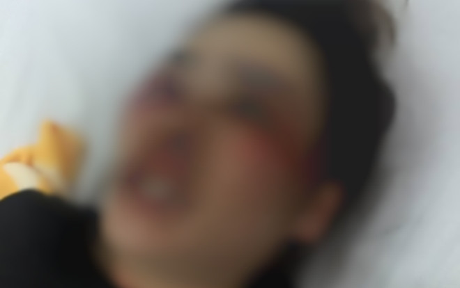 Giành ăn bánh xèo, nam sinh đánh cô gái trẻ gãy răng, thâm tím mặt mày Ảnh 2