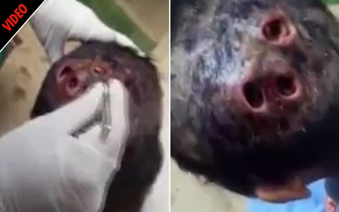 Kinh hãi: Bác sĩ gắp từng con giòi từ những lỗ sâu trên đầu bệnh nhân Ảnh 2