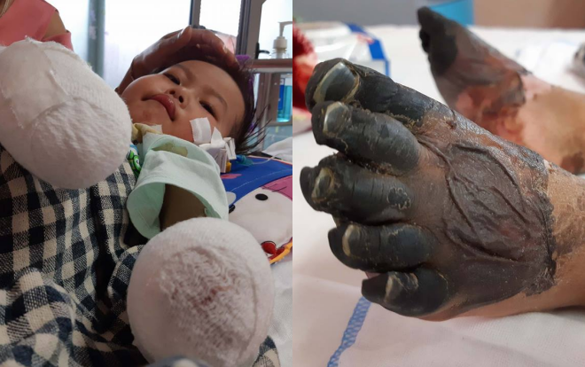 Cảm thương bé gái 3 tuổi phải cắt bỏ 2 bàn tay, chân vì bị hoại tử do nhiễm khuẩn huyết Ảnh 2