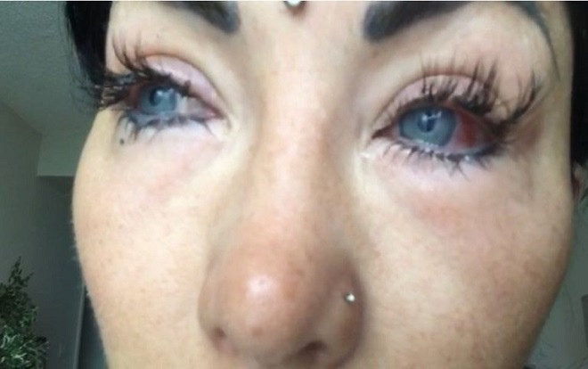 Phẫu thuật thay đổi màu mắt, 'hot girl' mạng xã hội tự rước họa vào thân Ảnh 2