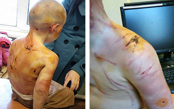 Không thể đếm đến 5, bé gái bị bạn trai của mẹ đánh đập dã man Ảnh 2