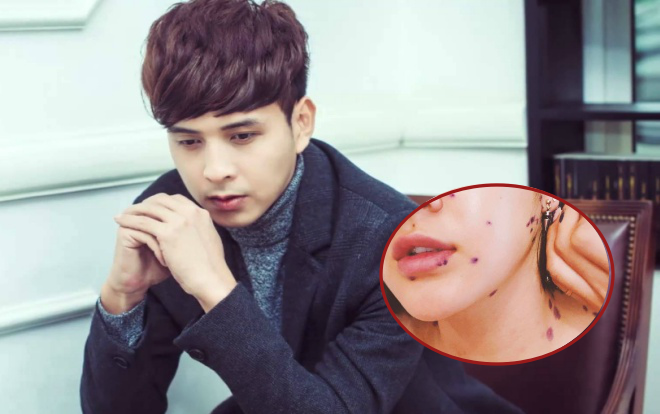 Nghe tin Bảo Anh bị thuỷ đậu, Hồ Quang Hiếu sốt sắng làm ngay điều này! Ảnh 2