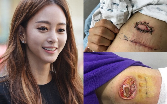Fan phát hoảng khi nhìn thấy vết thương lở loét ở chân mỹ nhân Han Ye Seul Ảnh 2