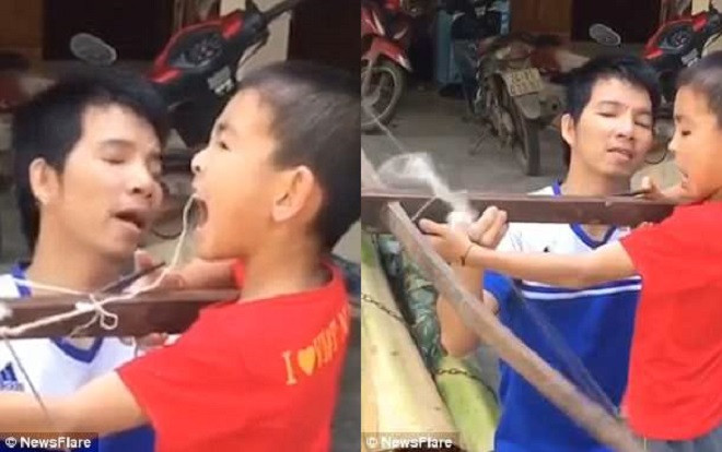 Báo Tây kinh ngạc trước màn nhổ răng bằng nỏ của hai cha con ở Việt Nam Ảnh 2